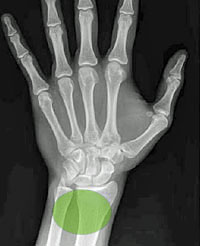 X-ray view of left hand / wrist to show tapping position